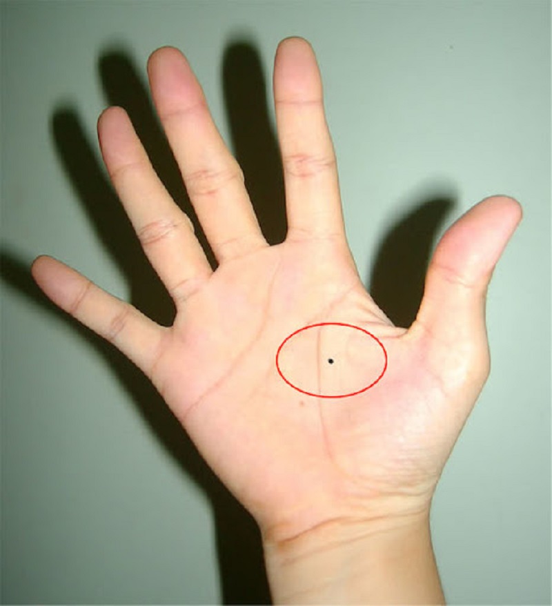 Nốt ruồi ở lòng bàn tay là gì