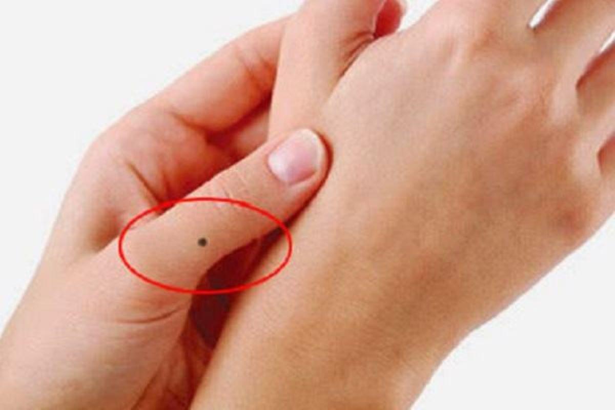 Nốt ruồi đen ở ngón tay cái