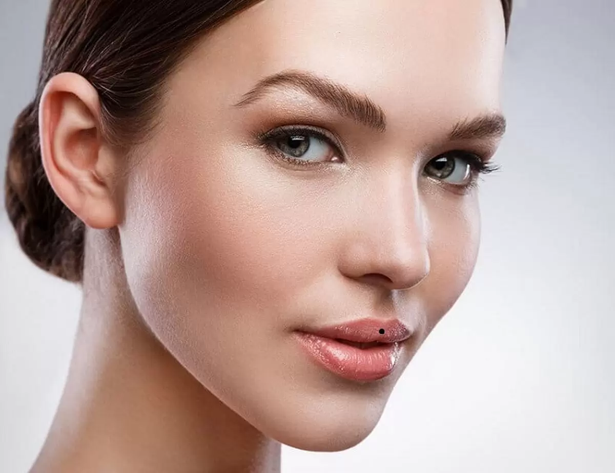 Nốt ruồi ở giữa môi trên