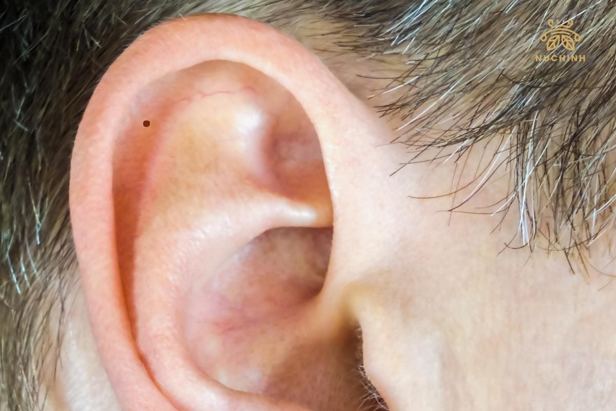 Nốt ruồi trong vành tai phải