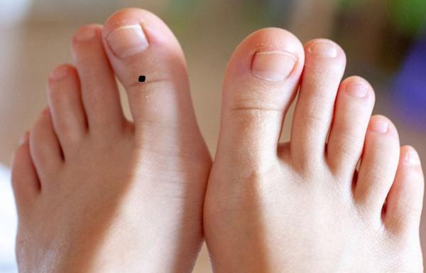 Nốt ruồi trên ngón chân cái