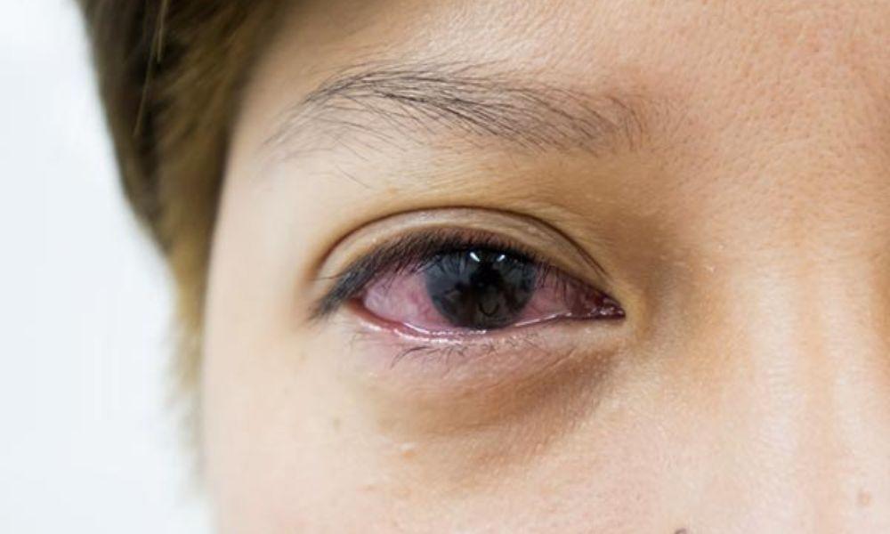 Mắc các bệnh lý liên quan đến mắt