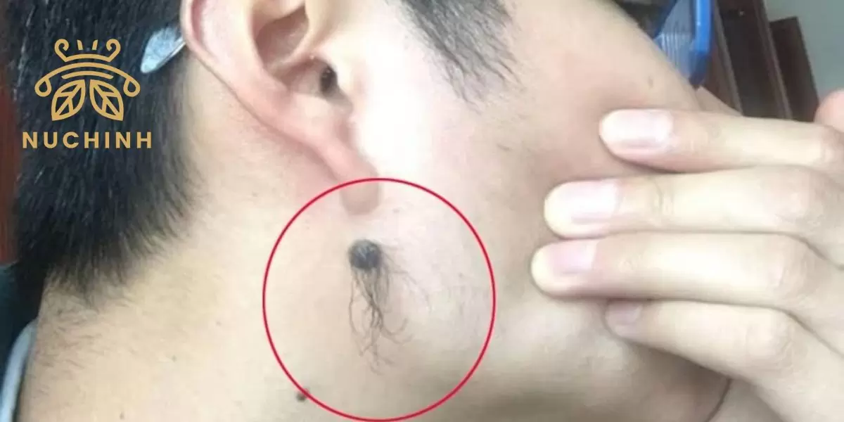 lông mọc trên nốt ruồi