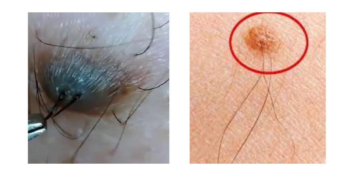 Nốt ruồi mọc lông ở vùng mông