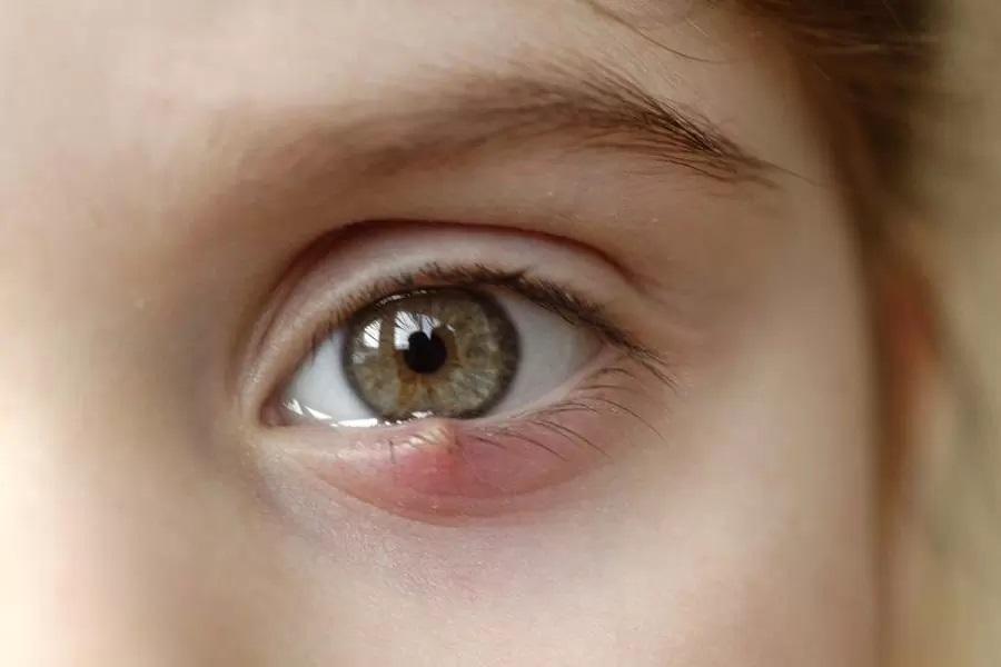 Mí mắt nổi mụn trắng nhỏ là gì? Nguyên nhân và Cách chữa trị