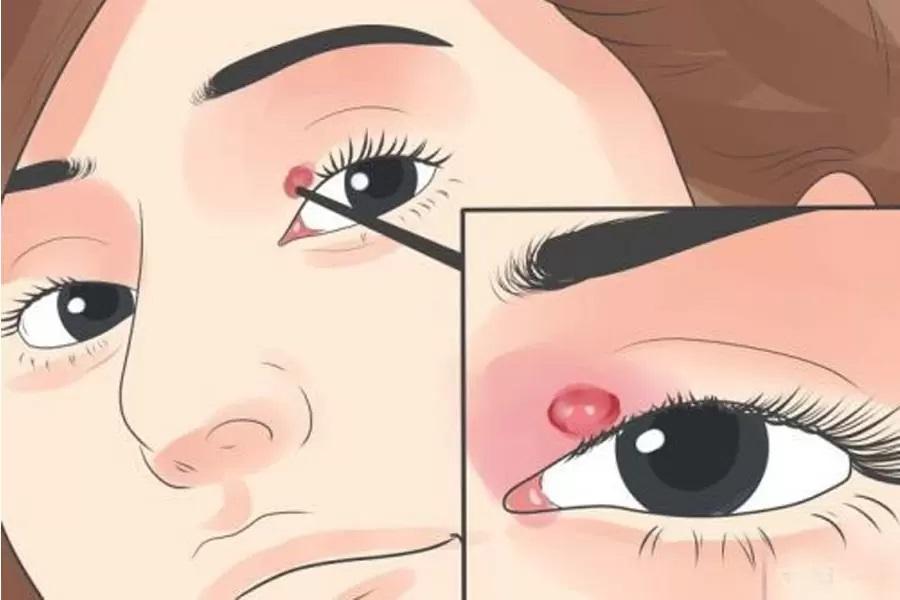 Các triệu chứng cho thấy mắt bị nổi mụn trắng