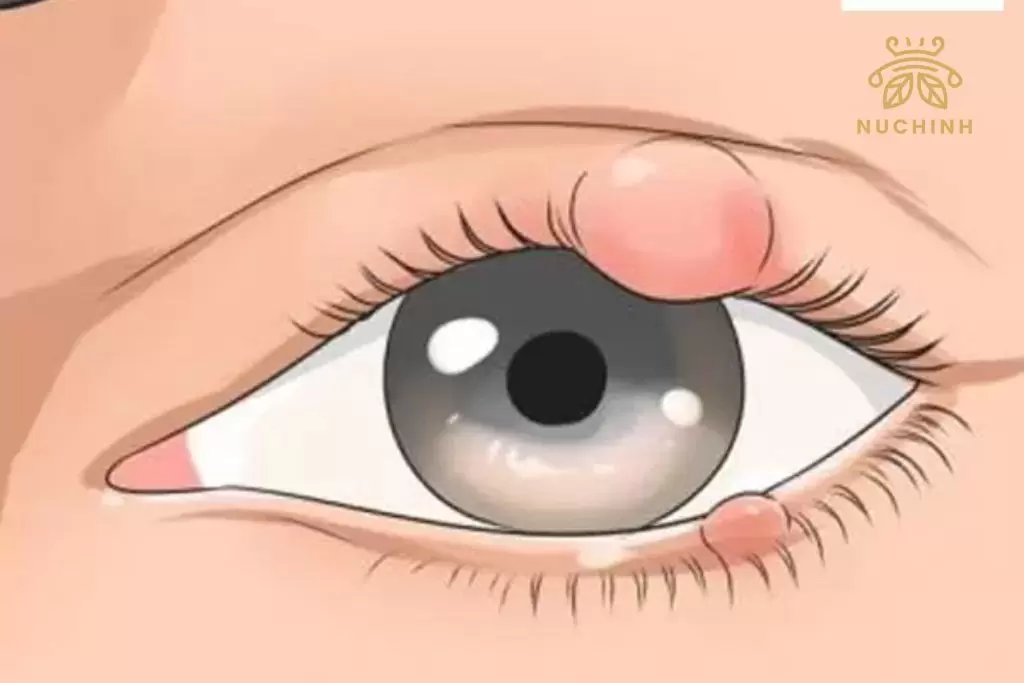 Mí mắt nổi mụn trắng nhỏ là gì? Nguyên nhân và Cách chữa trị