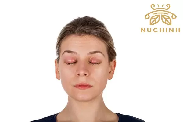 Mí mắt trên nổi mụn trắng nhỏ? Nguyên nhân và cách điều trị