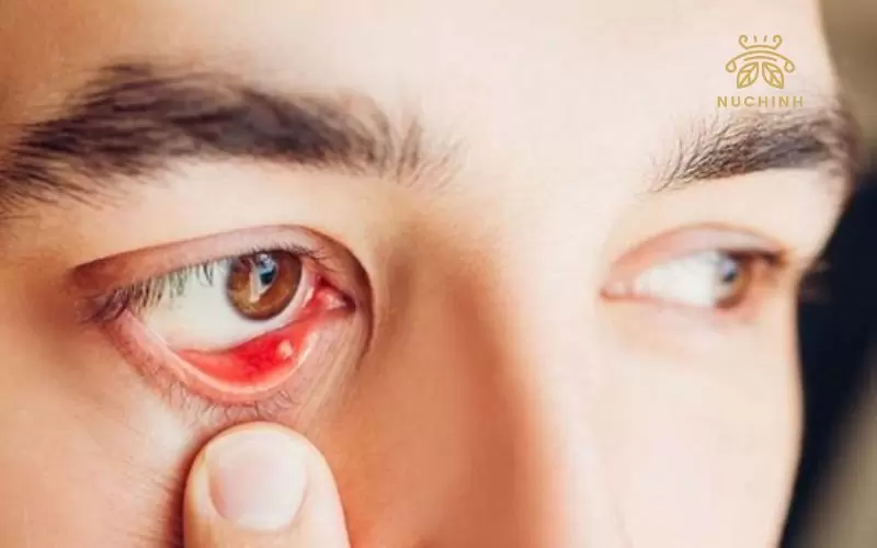 Mọc mụn trắng ở mí mắt dưới