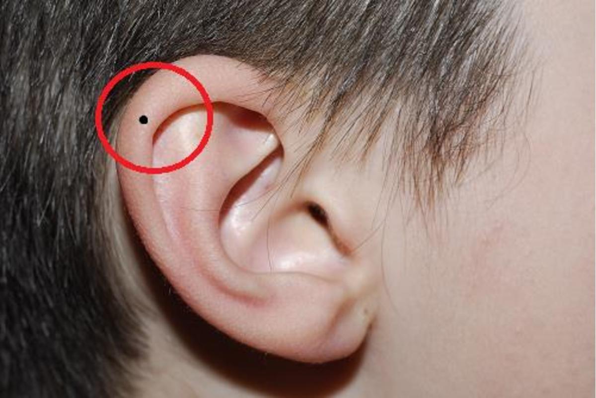 Hình ảnh nốt ruồi ở tai