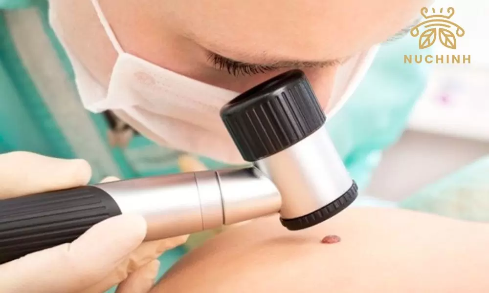 Top 12 những nốt ruồi son phú quý đại cát đại lợi trên cơ thể