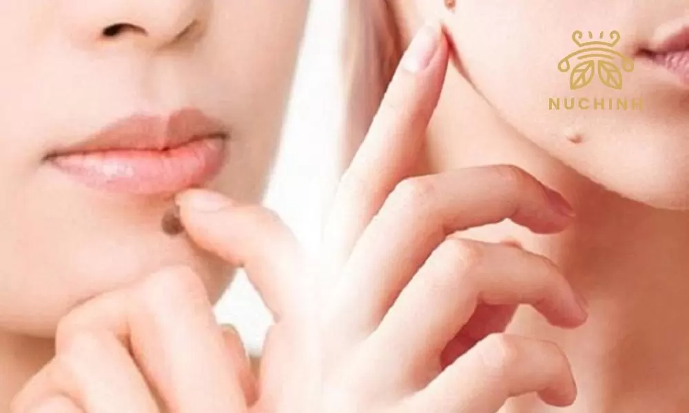 Những nốt ruồi xui xẻo trên mặt ở nam và nữ bạn cần biết