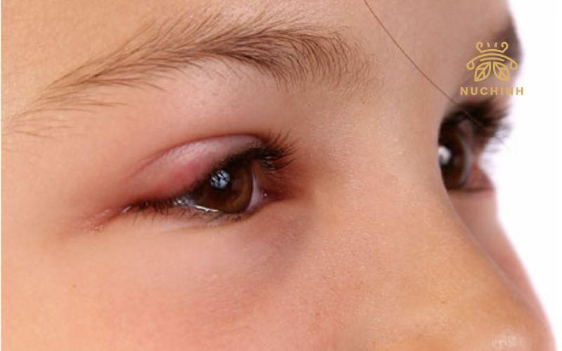 Nổi mụn ở mí mắt trên – Dấu hiệu, nguyên nhân và cách chữa trị tại nhà