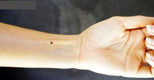 Nốt ruồi ở cổ tay trái phụ nữ