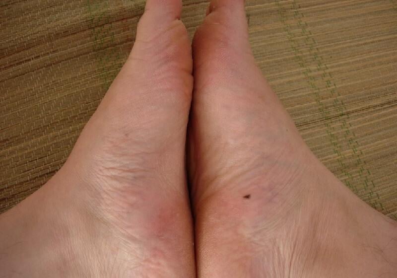 Ý nghĩa nốt ruồi ở mép bàn chân phải của phụ nữ