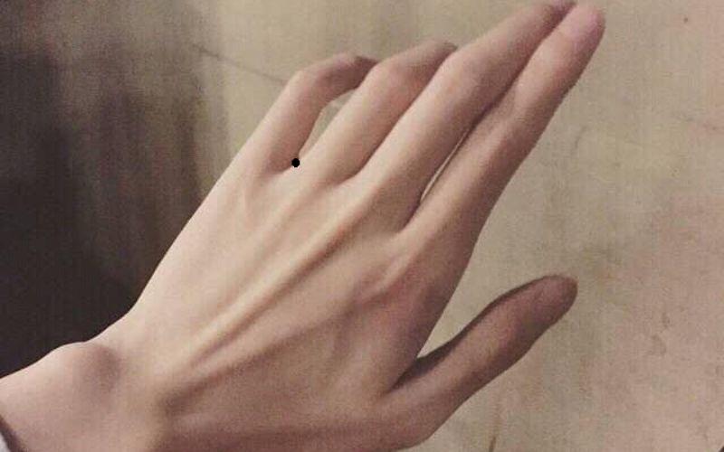 Nốt ruồi ở giữa kẽ ngón tay áp út và ngón út