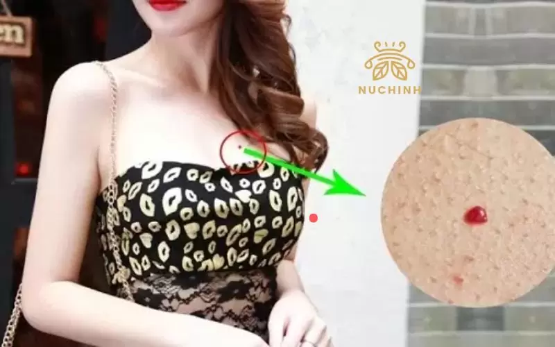 Nốt ruồi son ở ngực phải phụ nữ