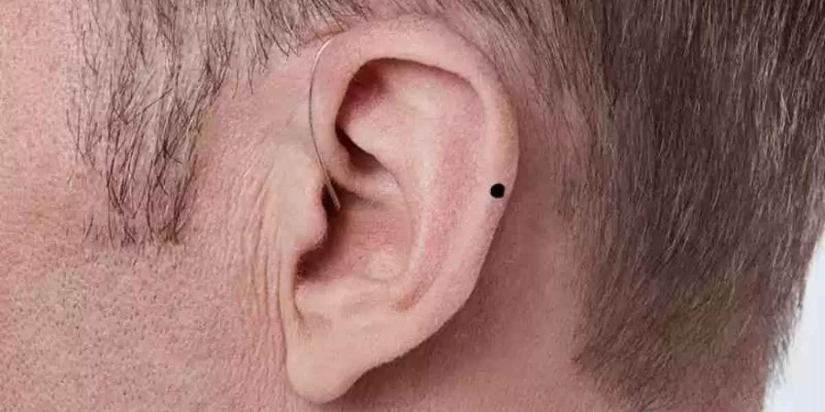 Có nên xóa nốt ruồi ở vành tai không?