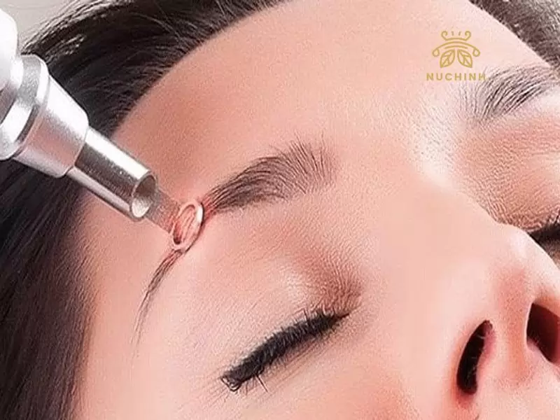 Xoá xăm lông mày có hết không